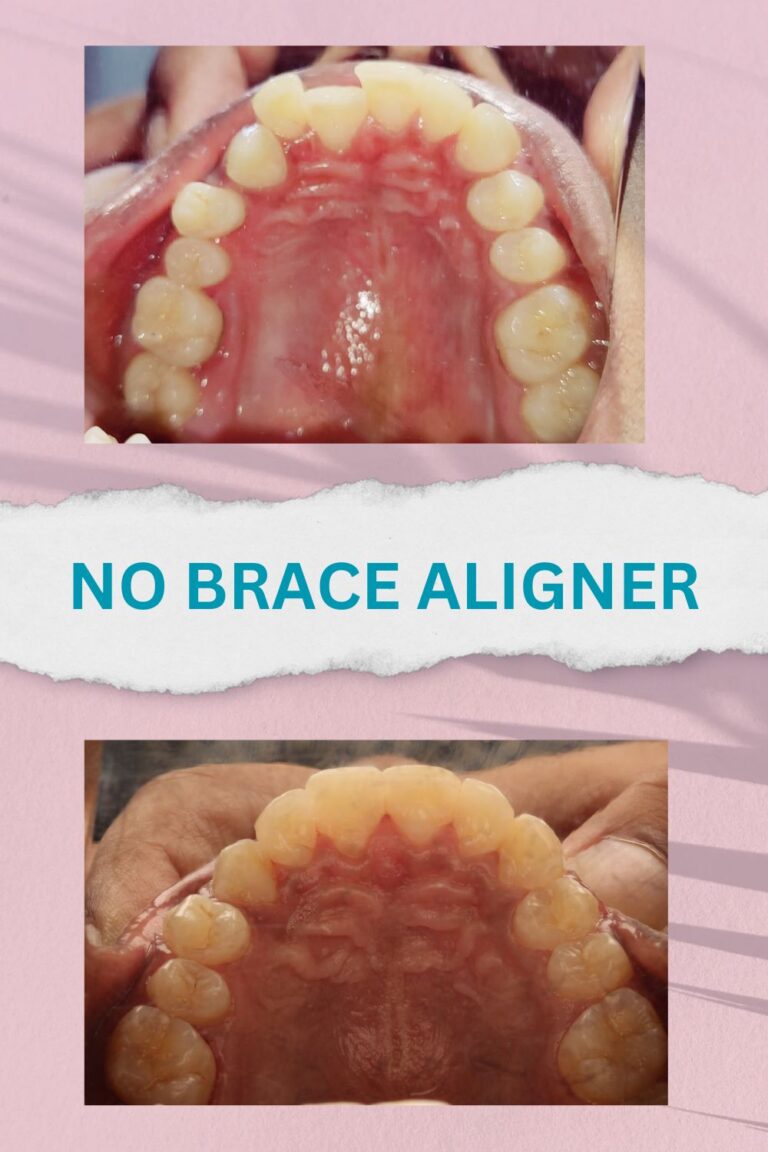 No brace aligners best results and proofs (1)