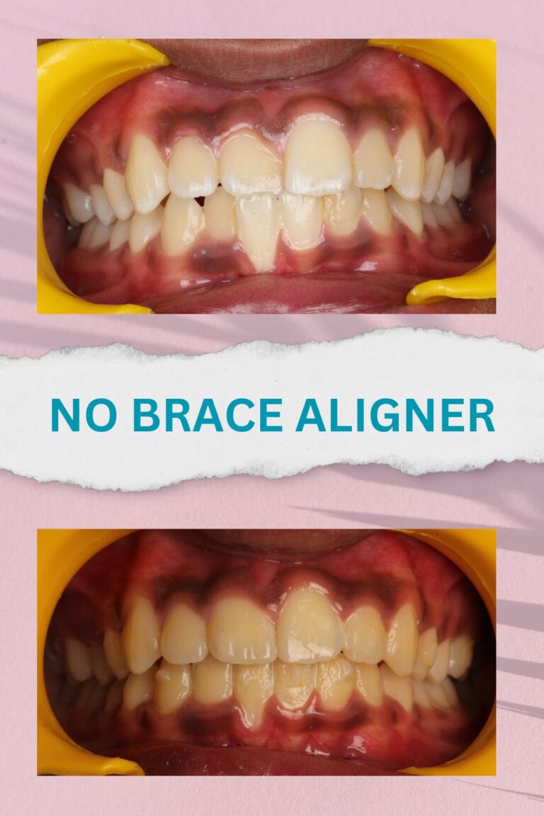 No brace aligners best results and proofs (11)