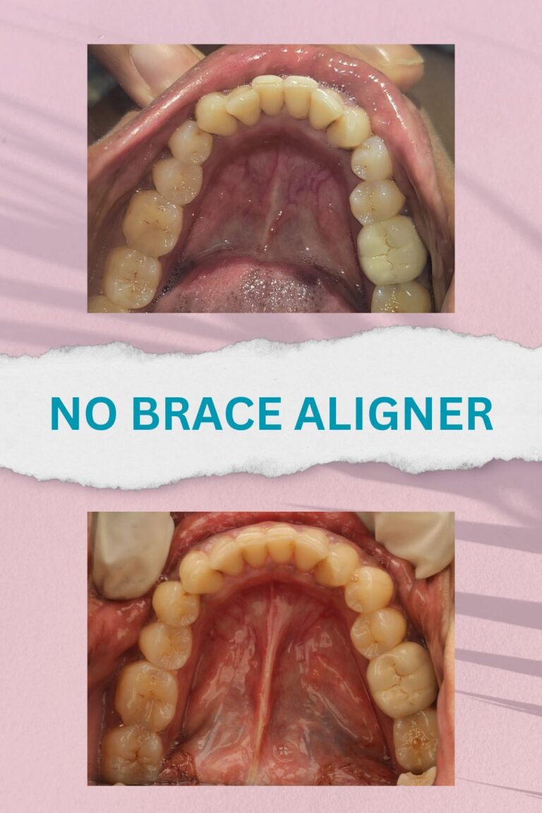 No brace aligners best results and proofs (12)