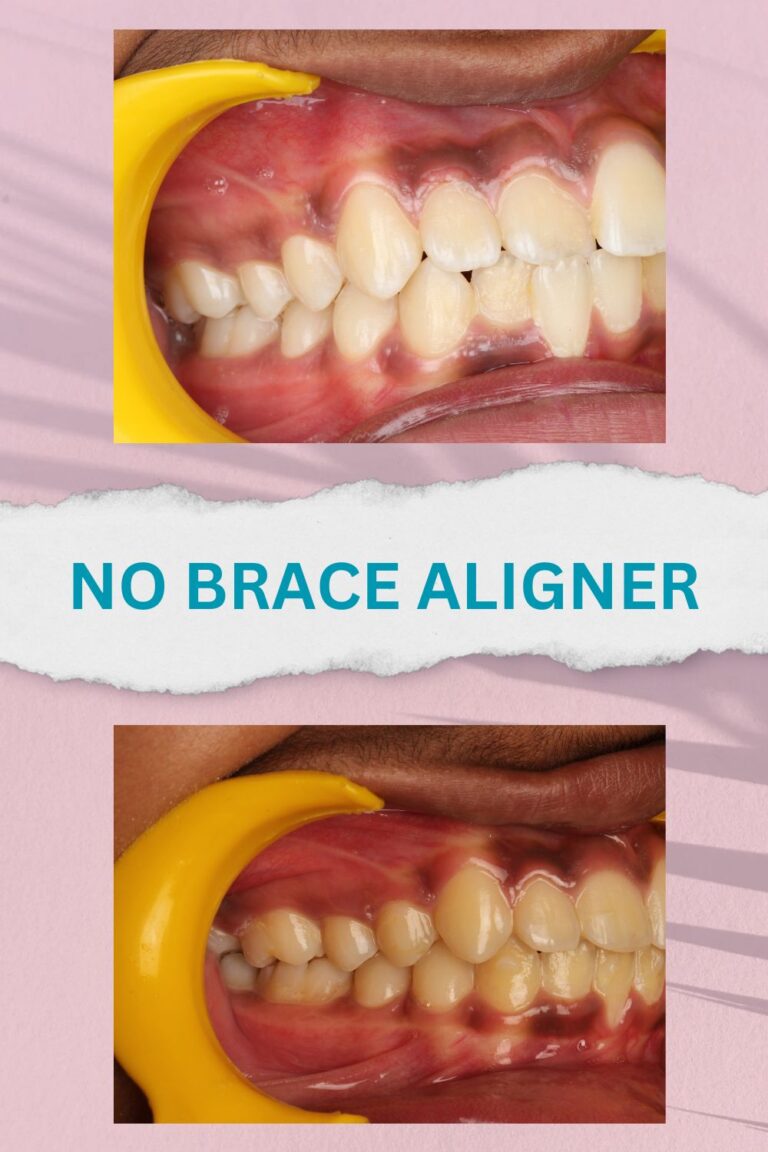 No brace aligners best results and proofs (13)
