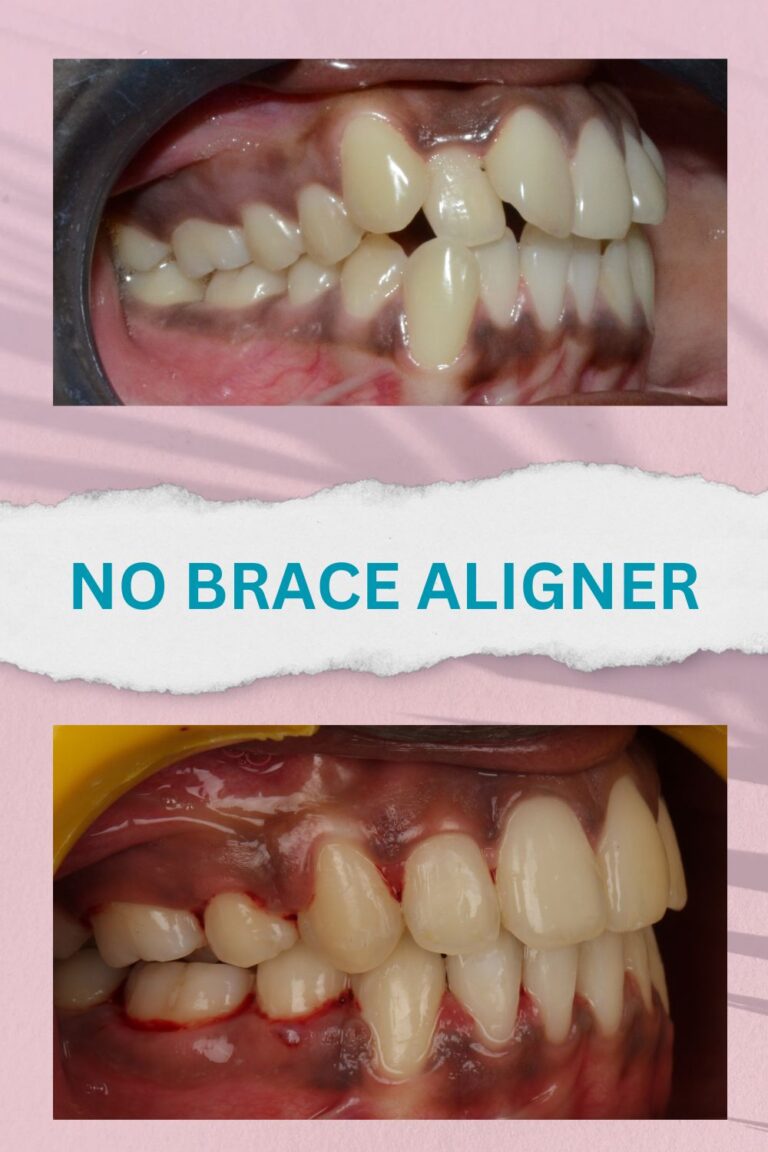 No brace aligners best results and proofs (15)