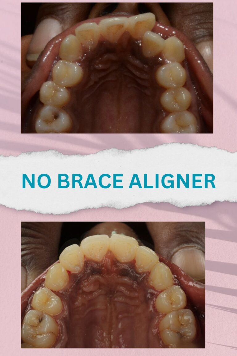 No brace aligners best results and proofs (2)