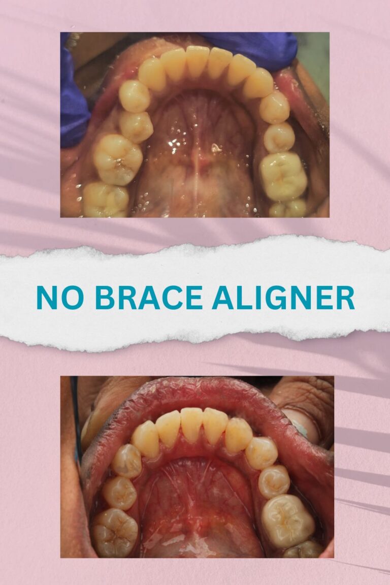 No brace aligners best results and proofs (3)