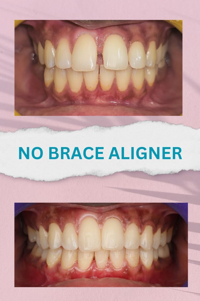 No brace aligners best results and proofs (4)