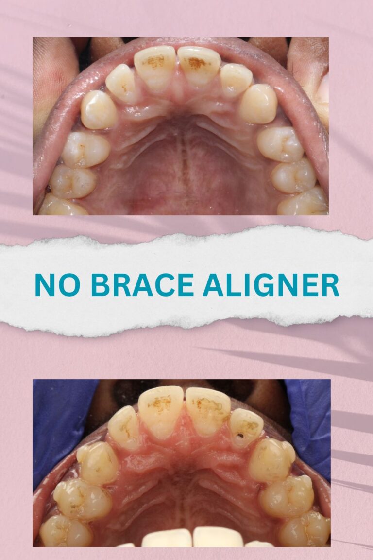 No brace aligners best results and proofs (5)