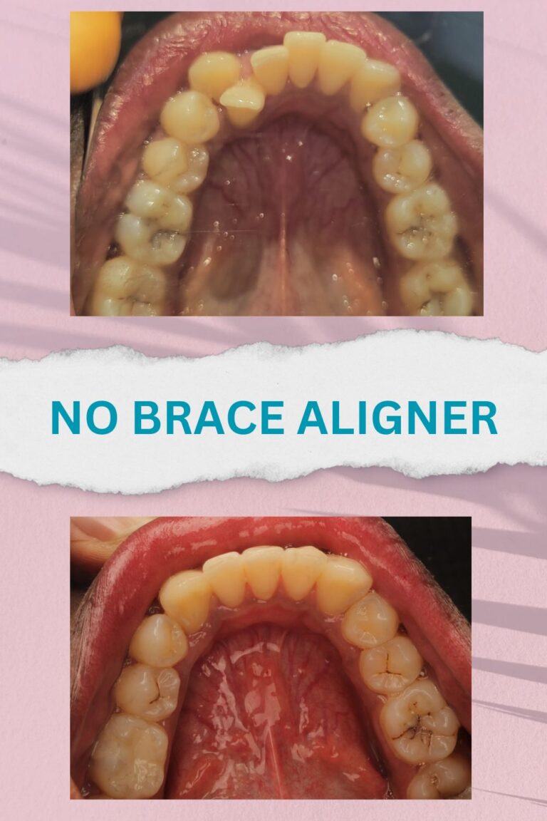 No brace aligners best results and proofs (6)