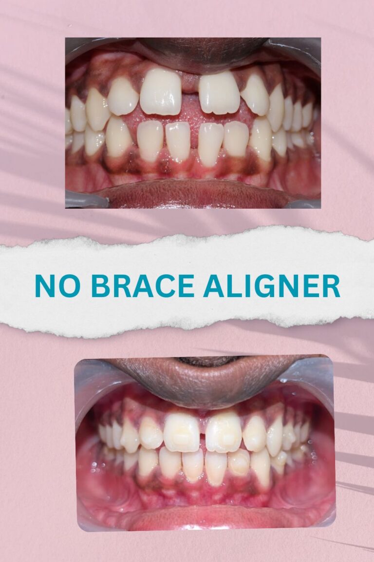 No brace aligners best results and proofs (7)